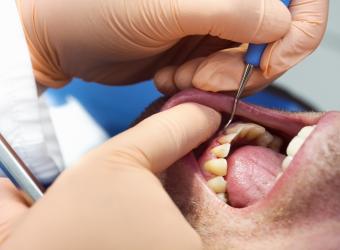 The Stages of Periodontitis: Understanding the Progression